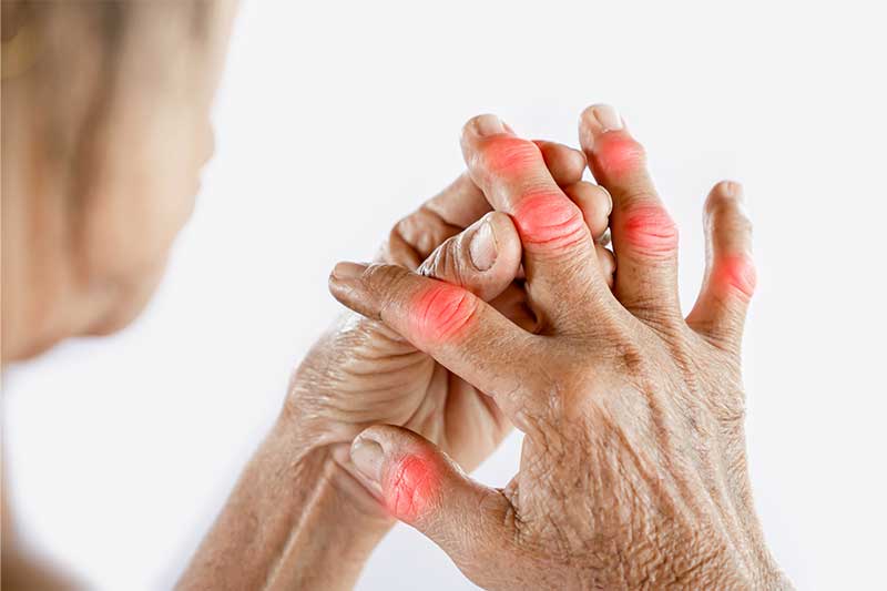 Treatment and Medications for Arthritis